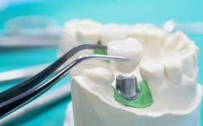 Tooth and Dental Crowns at US Dental in Columbus, OH