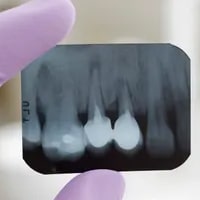 Extractions Extractions