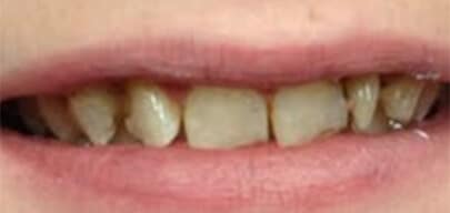 Before Treatment For Crooked Teeth