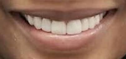 After Treatment For Lost Teeth Replacement