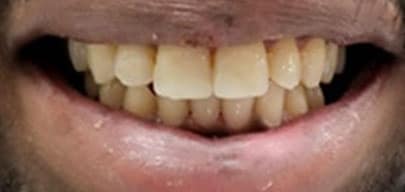 Después de tratamiento para dientes quebrados en Ohio