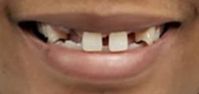 Antes de tratamiento para dientes faltantes