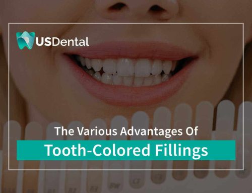 The Various Advantages Of Tooth-Colored Fillings