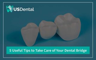 5-useful-tips-to-take-care-of-your-dental-bridge