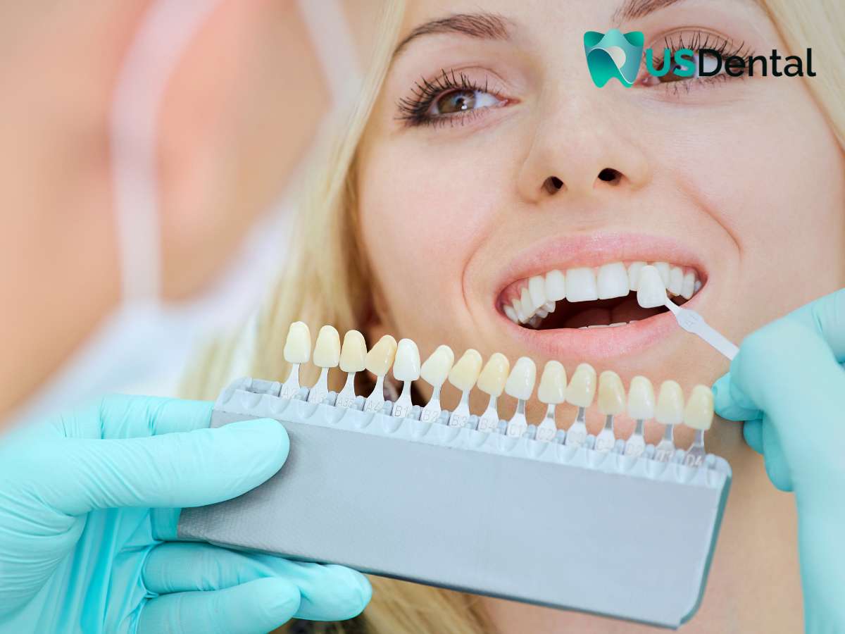 Dentist comparing porcelain crown shades with a patient's teeth to ensure a perfect match for maintaining porcelain crowns