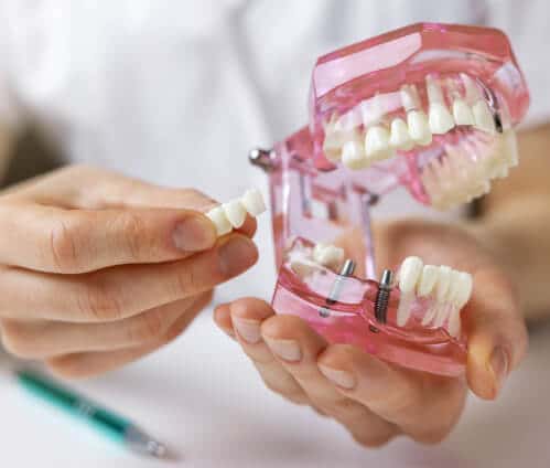 Dental Professional Demonstrating Dental Bridge Placement